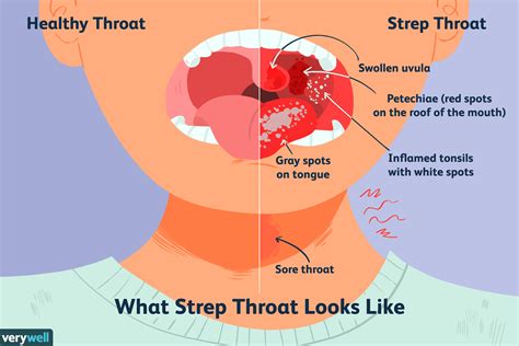 Can Strep Throat Lead to Serious Complications?