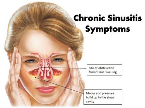 Is It a Sinus Infection or COVID-19? Understand Your Symptoms