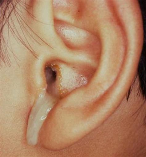 Understanding Ear Infections and Diarrhea