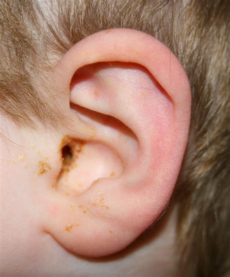 Understanding Ear Infections: Causes, Symptoms, and Treatment