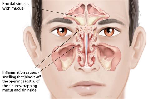 Sinusitis Information