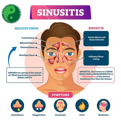 Understanding Sinusitis: Symptoms, Causes, and Treatment Options