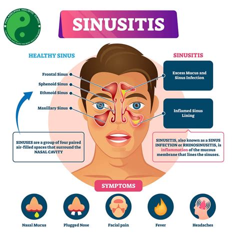 Understanding Sinusitis: Symptoms, Treatment, and COVID-19 Comparisons