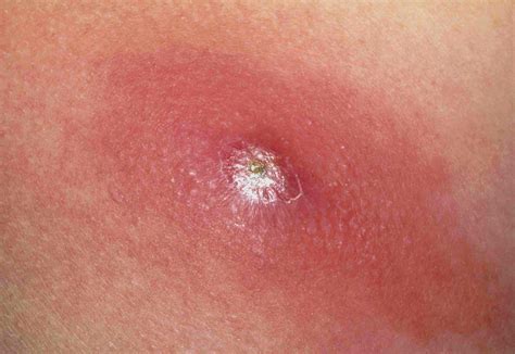 Understanding Skin Infections: What Causes Boils and Carbuncles?