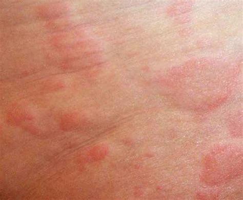 Understanding Skin Rashes Causes Symptoms And Treatments 1 