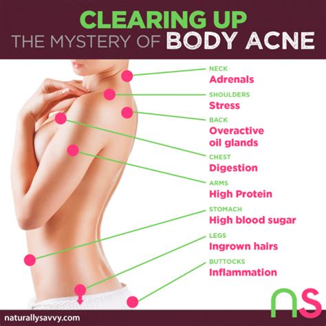 Understanding the Causes of Adult Female Acne and Treatment Options