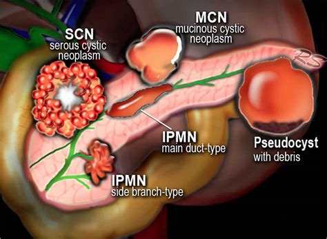 What Are Cysts? An Insight Into Their Types and Effects on the Body