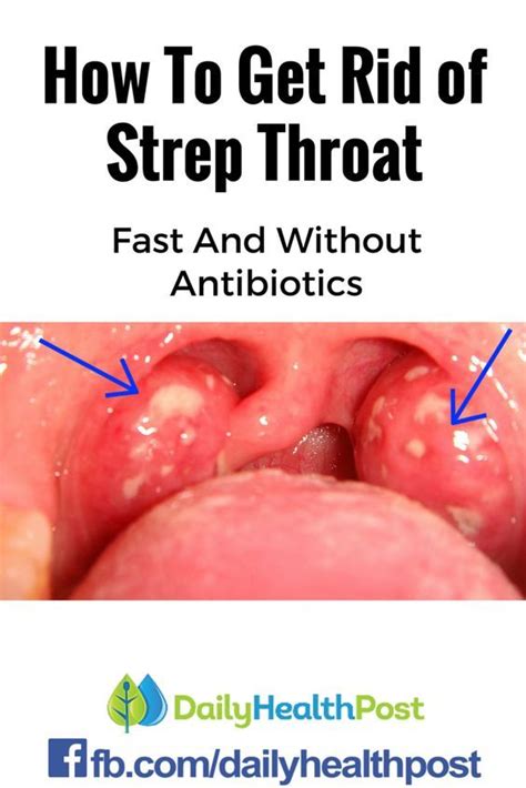 Sore Throats | McGovern Medical School