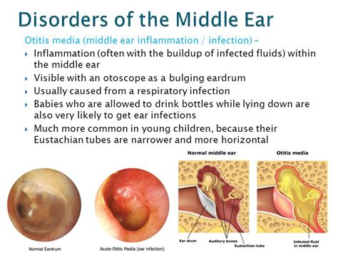 Exploring the Link Between COVID-19 and Inner Ear Infections: A Comprehensive Study