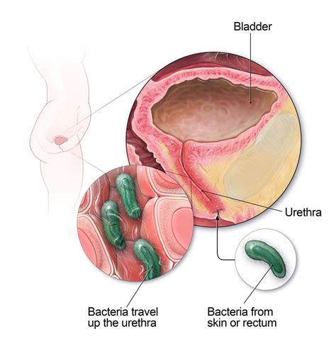 Exploring the Rise of Antibiotic-Resistant Urinary Tract Infections: What You Need to Know