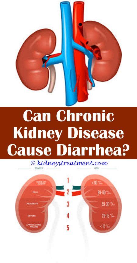 Exploring the Surprising Connection Between Kidney Disease and Gut Inflammation