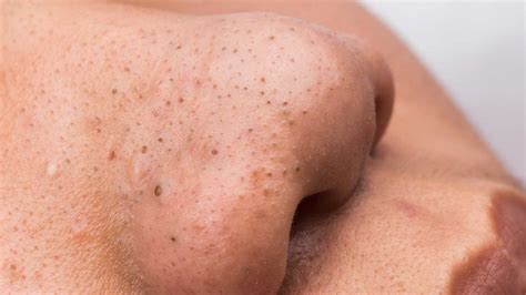 Understanding Adult Acne