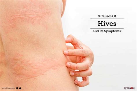 Understanding and Managing Hives