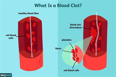 Understanding Blood Clots: Causes, Risks, and Prevention Strategies