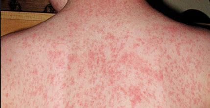 Understanding Complex Skin Rashes: Causes and Treatments