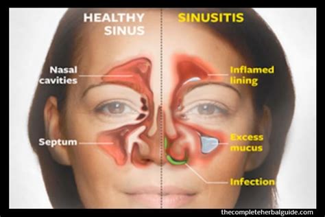 Understanding Deviated Septum