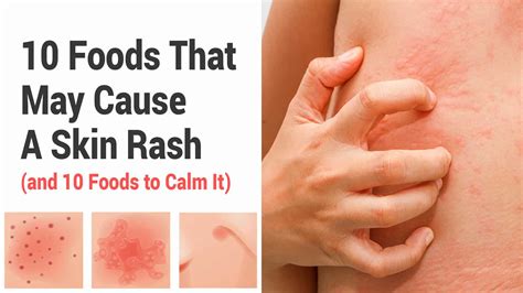 Understanding Drug Rashes: Identifying Causes and Effective Treatments