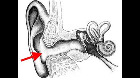 Understanding Ear Infections and Their Impact on Children