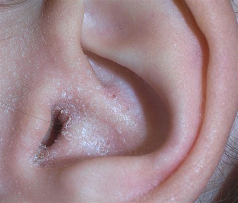 Understanding Ear Infections