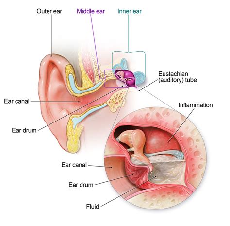 Understanding Ear Infections: Causes, Symptoms, and Treatments