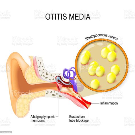 Understanding Ear Infections