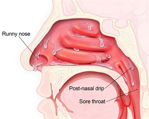 Understanding Ear Infections in Children