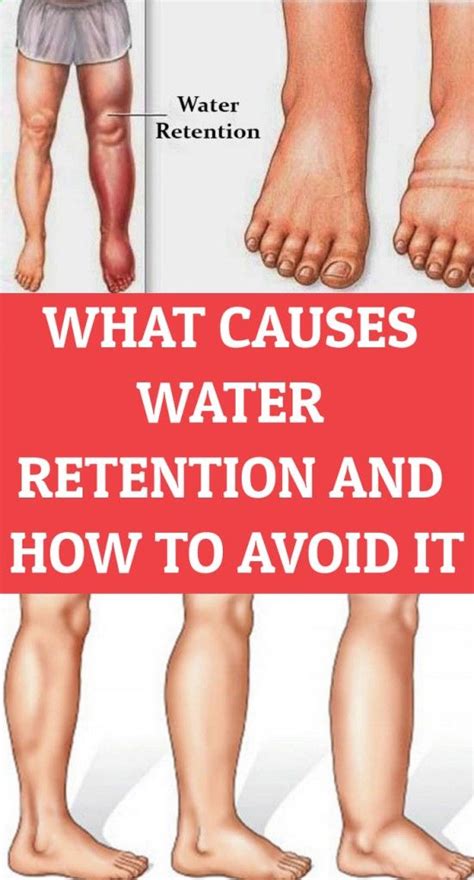 Understanding Fluid Retention: Its Impact on Heart Health and Weight Management