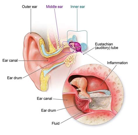 Understanding Haemophilus Influenzae Infections and Eye and Ear Conditions in Children