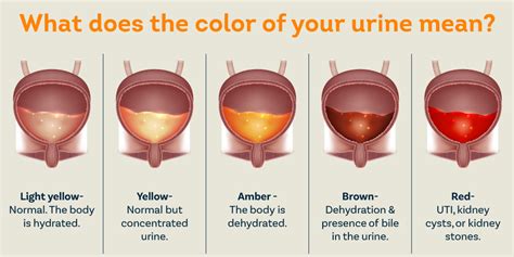 Understanding Hematuria