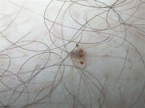 Understanding Human Lice: Types, Symptoms, and Control Methods