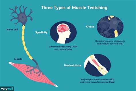 Understanding Involuntary Muscle Twitches: Causes and Management