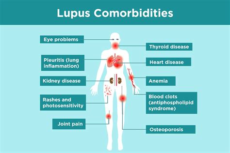 Understanding Lupus: Symptoms, Causes, and Treatment Options