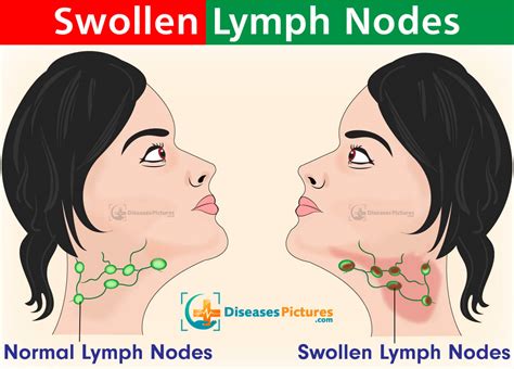 Understanding Lymphadenopathy