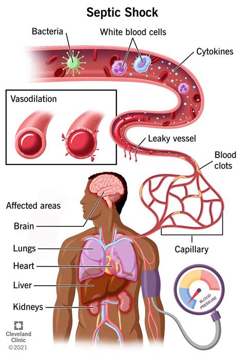 Understanding Medical Shock: Types, Causes, and Treatments