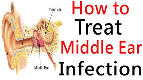 Understanding Middle Ear Infections