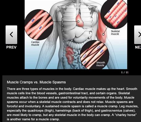 Understanding Muscle Cramps