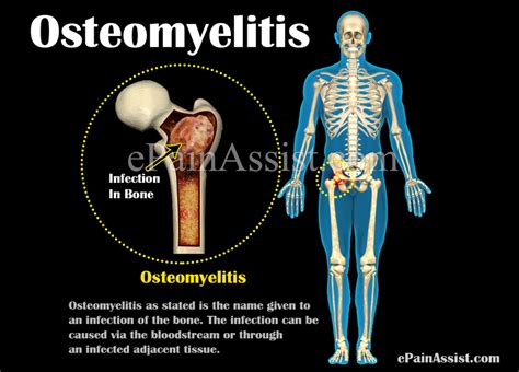 Understanding Osteomyelitis