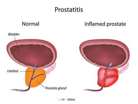 Understanding Prostatitis