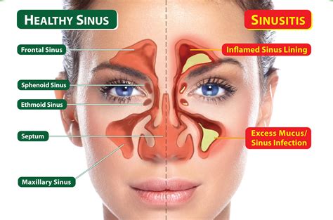 Understanding Sinus Headaches