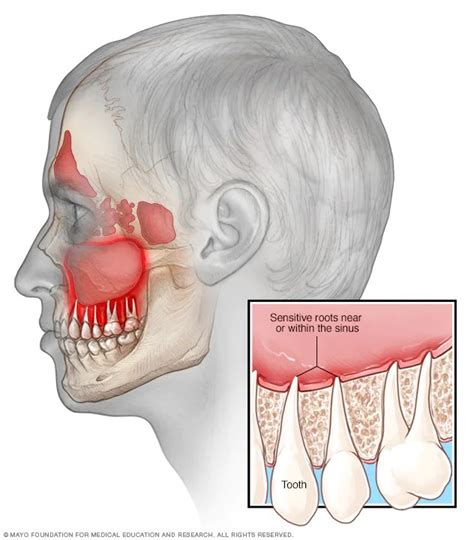 Understanding Sinusitis: Causes, Symptoms, and Treatment Options