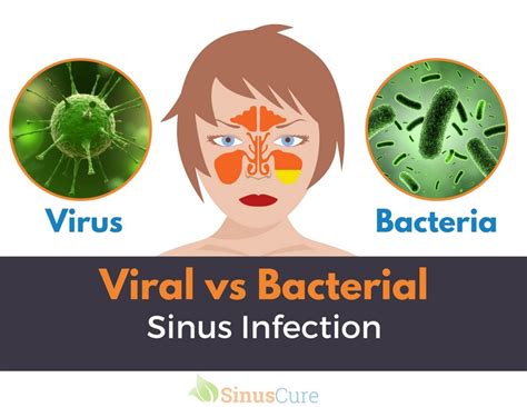 Understanding Sinusitis