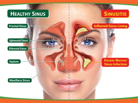 Understanding Sinusitis: Causes, Symptoms, and Treatments