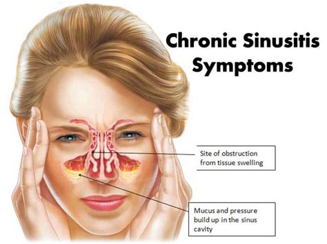 Understanding Sinusitis: Symptoms, Causes, and Treatments