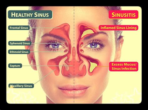 Understanding Sinusitis: Symptoms, COVID-19 Comparisons, and Treatment Options