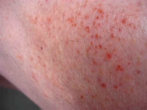 Understanding the Causes and Treatments of Various Skin Rashes