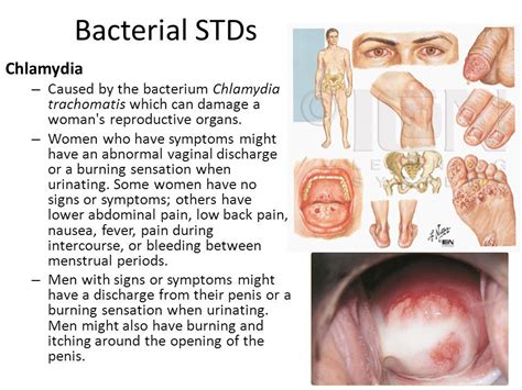 Understanding the Complexities of STDs: Symptoms, Risks, and Prevention