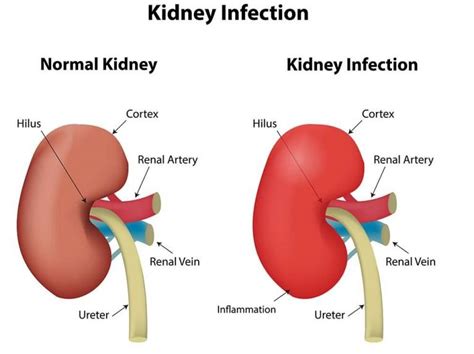 Understanding the Link Between High Blood Pressure, Kidney Health, and Lifestyle Choices