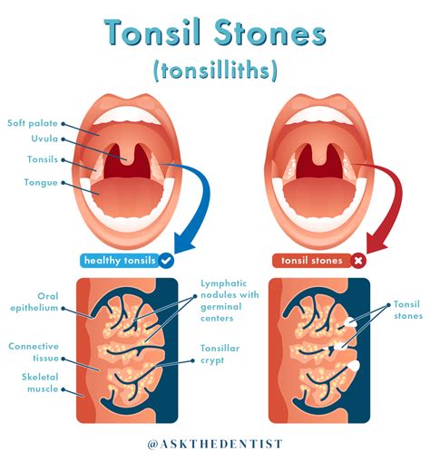 Understanding Tonsil Stones