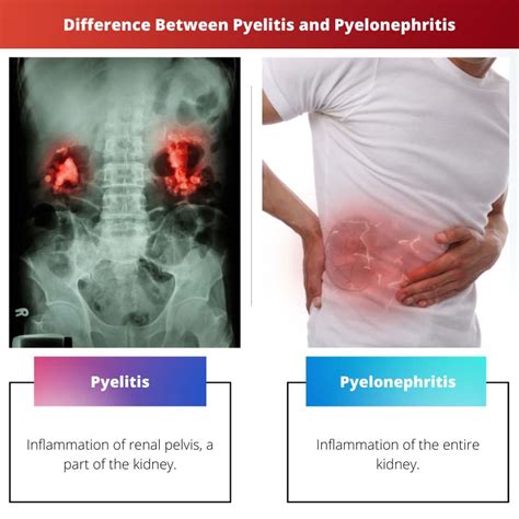 Understanding Urinary Tract Infections and Pyelonephritis