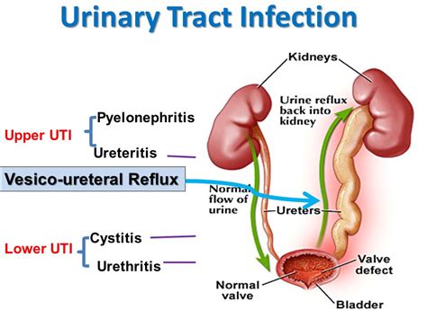 Understanding Urinary Tract Infections